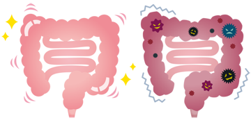 健康な大腸と病気の大腸